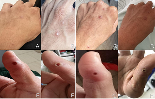 This figure demonstrates newly developing monkeypox lesions along the